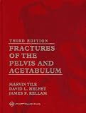 Fractures of the Pelvis and Acetabulum