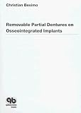 Removable Partial Dentures on Osseointegrated Implants: Principles of Treatment Planning and Prosthetic Rehabilitation in Edentulous Mandible